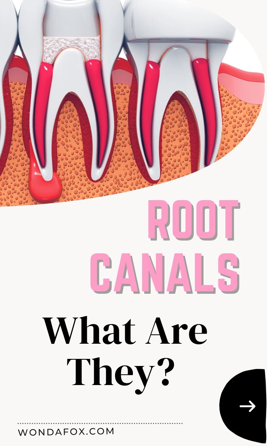 Root Canals: What Are They?