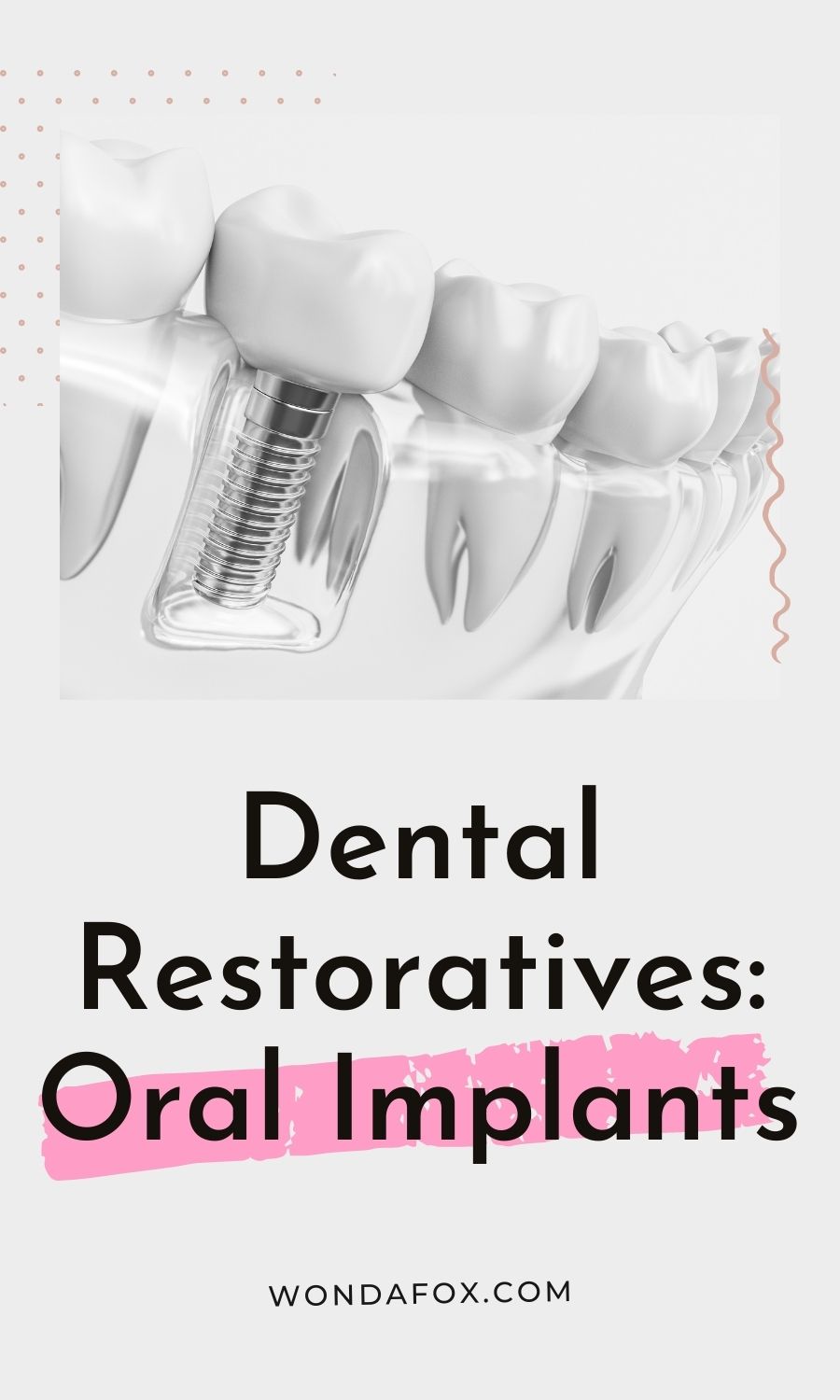 Dental Restoratives: Oral Implants  