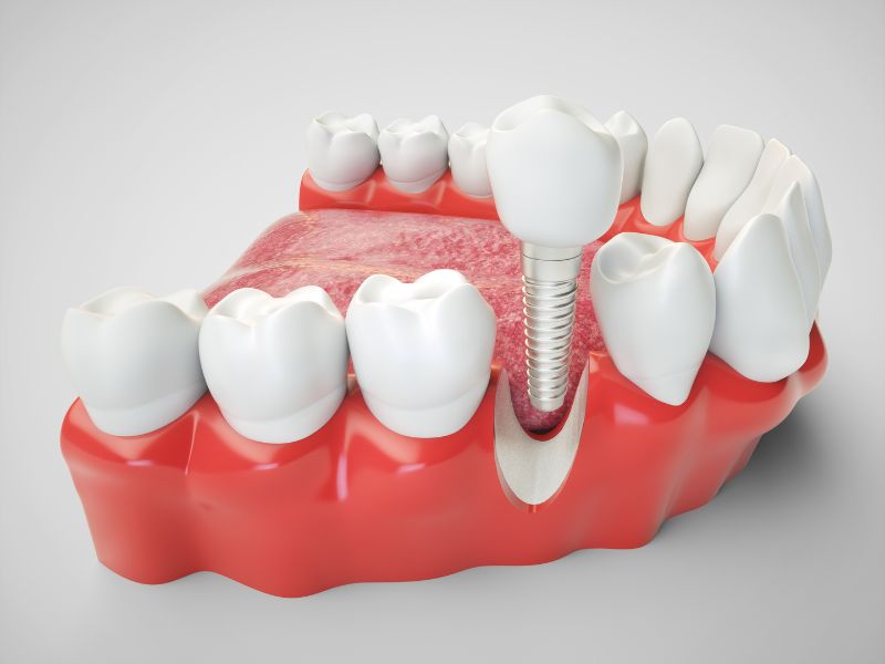 Why Choose A Dental Implant To Replace Your Missing Tooth?